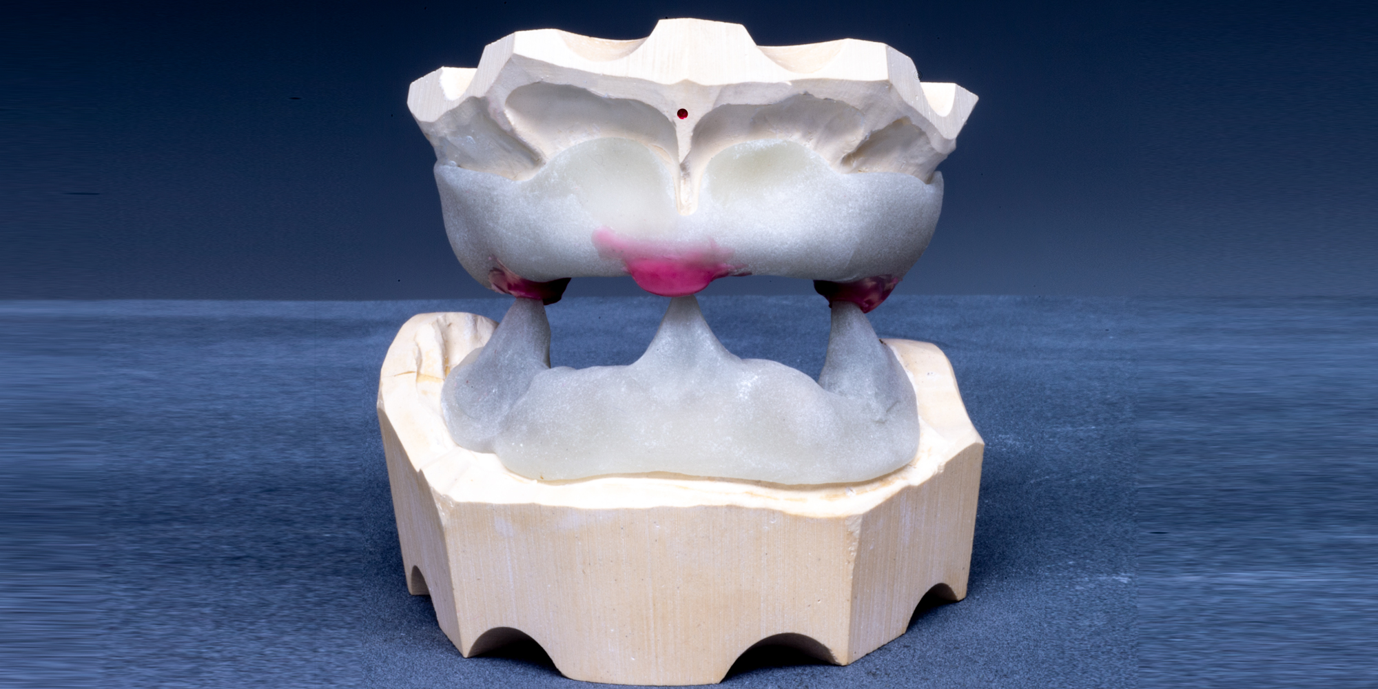 _RCW9756-Occlusal-Registration-Models. by Ron Winter of Fabulous Teeth @ Se4aside Dental Laboratory & Clinicjpg