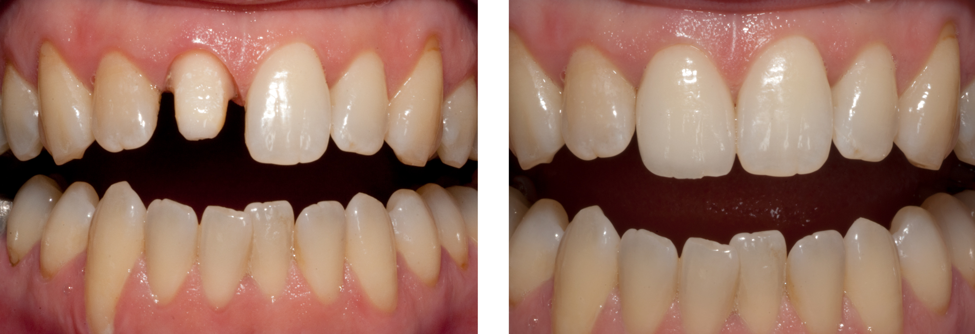 Single-Front Tooth By Ron Winter of Fabulous Teeth @ Seaside Dental Laboratory $ Clinic Takapuna Auckland New Zealand.jpg