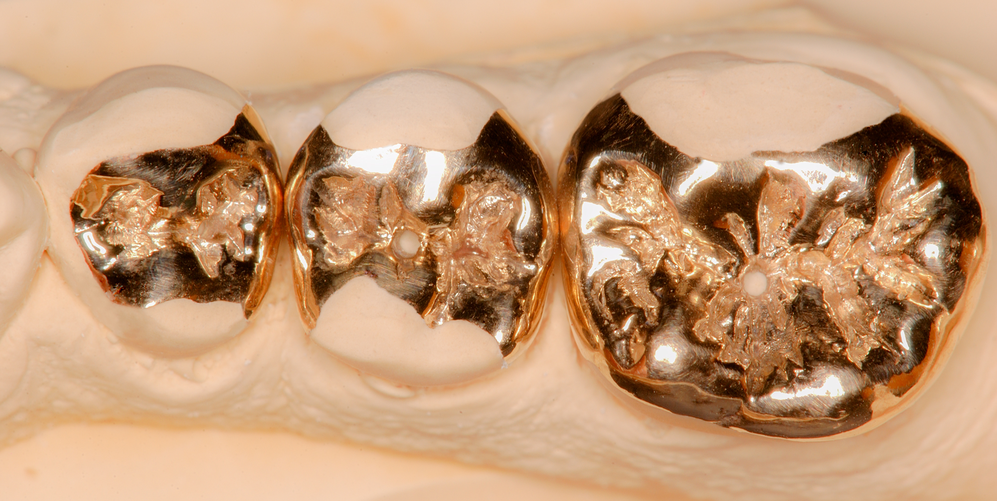 Three-Gold-Onlays-with-Vents ron winter of fabulous teeth @ seaside dental laboratory & clinic Takapuna Auckland New Zealand.jpg