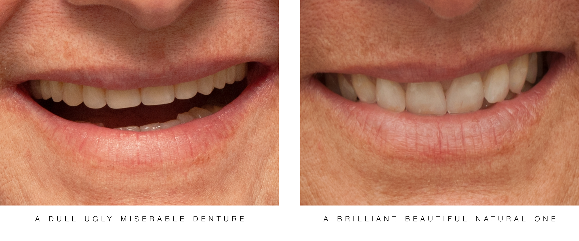 A-dull-Ugly-denture by Ron Winter of Fabulous Teeth @ Seaside Dental Laboratory & Clinic.jpg