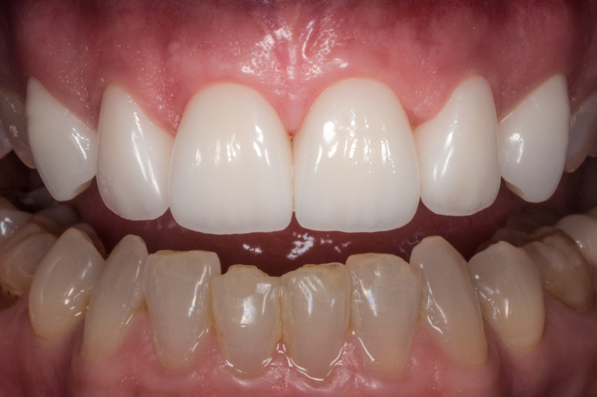 6 Upper front teeth by Ron Winter of Fabulous Teeth @ Seaside Dental Laboratory & Clinic Takapuna Auckland New Zealand .jpg