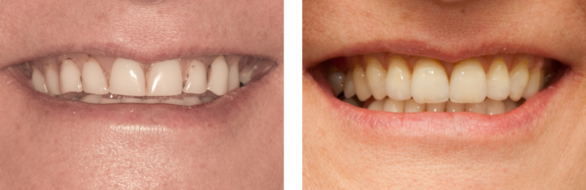 Before--After-A-Full-Upper-denture-by-Ron-Winter-of-Fabulous-Teeth--Seaside-Dental-Laboratory-Takapuna-Auckland-New-Zealand.jpg