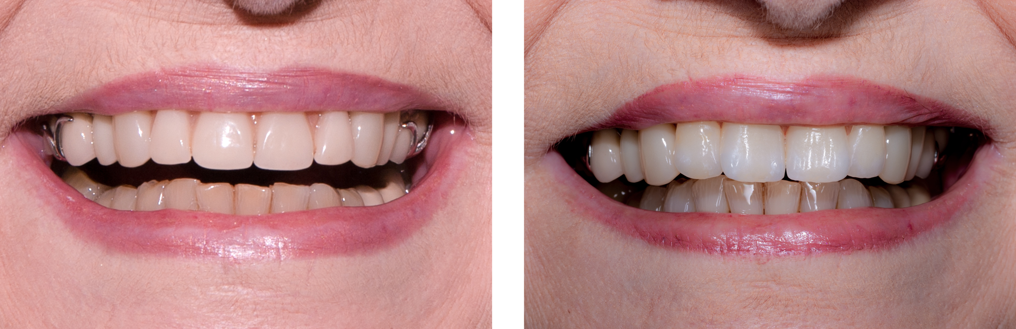 Four-ceramic-hand-made-front-teeth-on-a-Metal-Partial-denture_Ron_Winter_Seasade_Dental_Laboratory.jpg