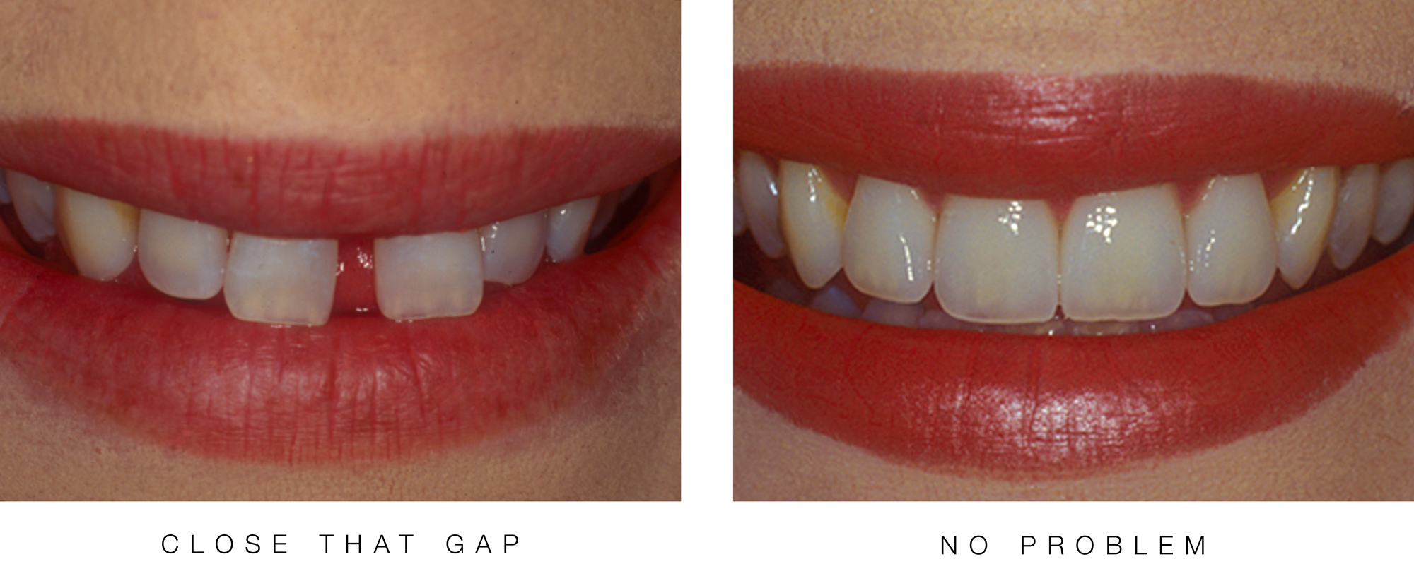 Close-That-Gap---No-Problem by Ron Winter of Fabulous Teeth 2 Seaside Dental Laboratory & Clinic .jpg