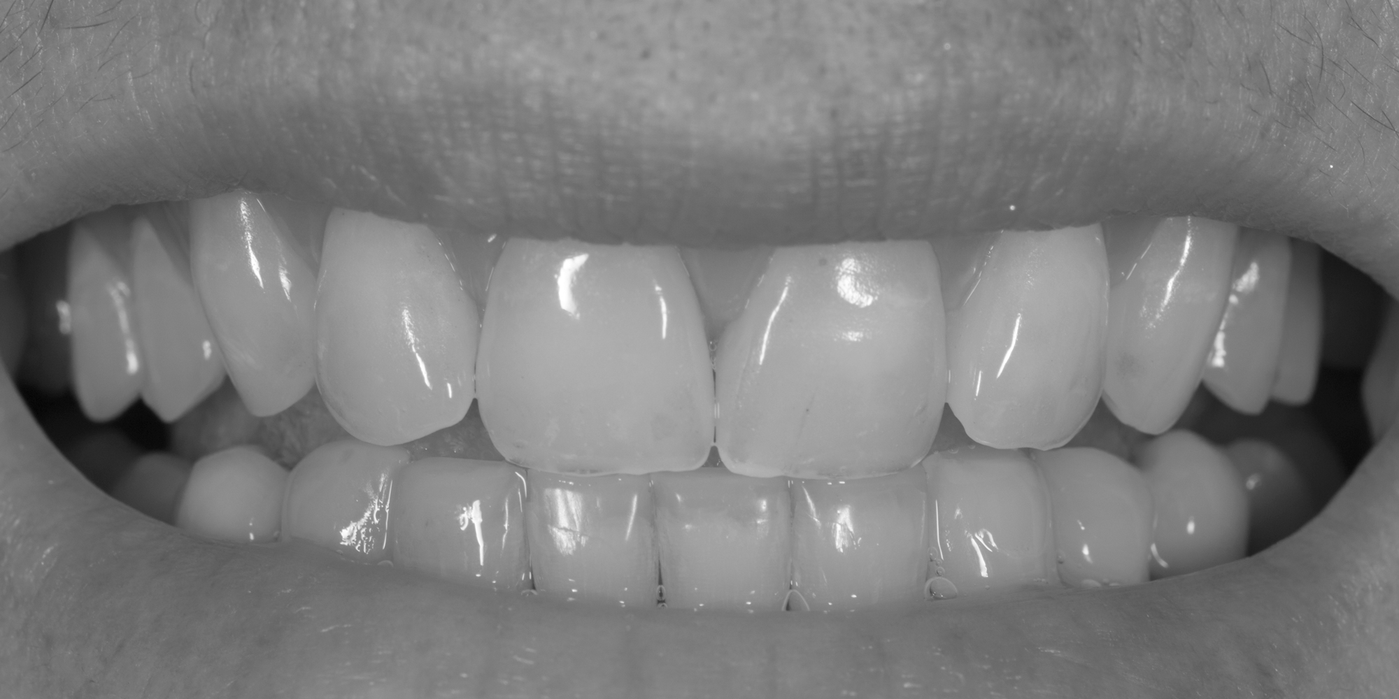 _RCW3406-B-n-W-Full upper denture ceramic teeth by Ron Winter of Fabulous Teeth @ Seaside Dental Laboratory & Clinic Auckland New Zealand jpg