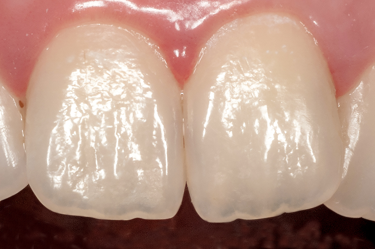 _RCW9507-Minutia-Sample-Central-Incisors by Ron Winter of Fabulous Teeth @ Seaside Dental Laboratory & Clinic.jpg