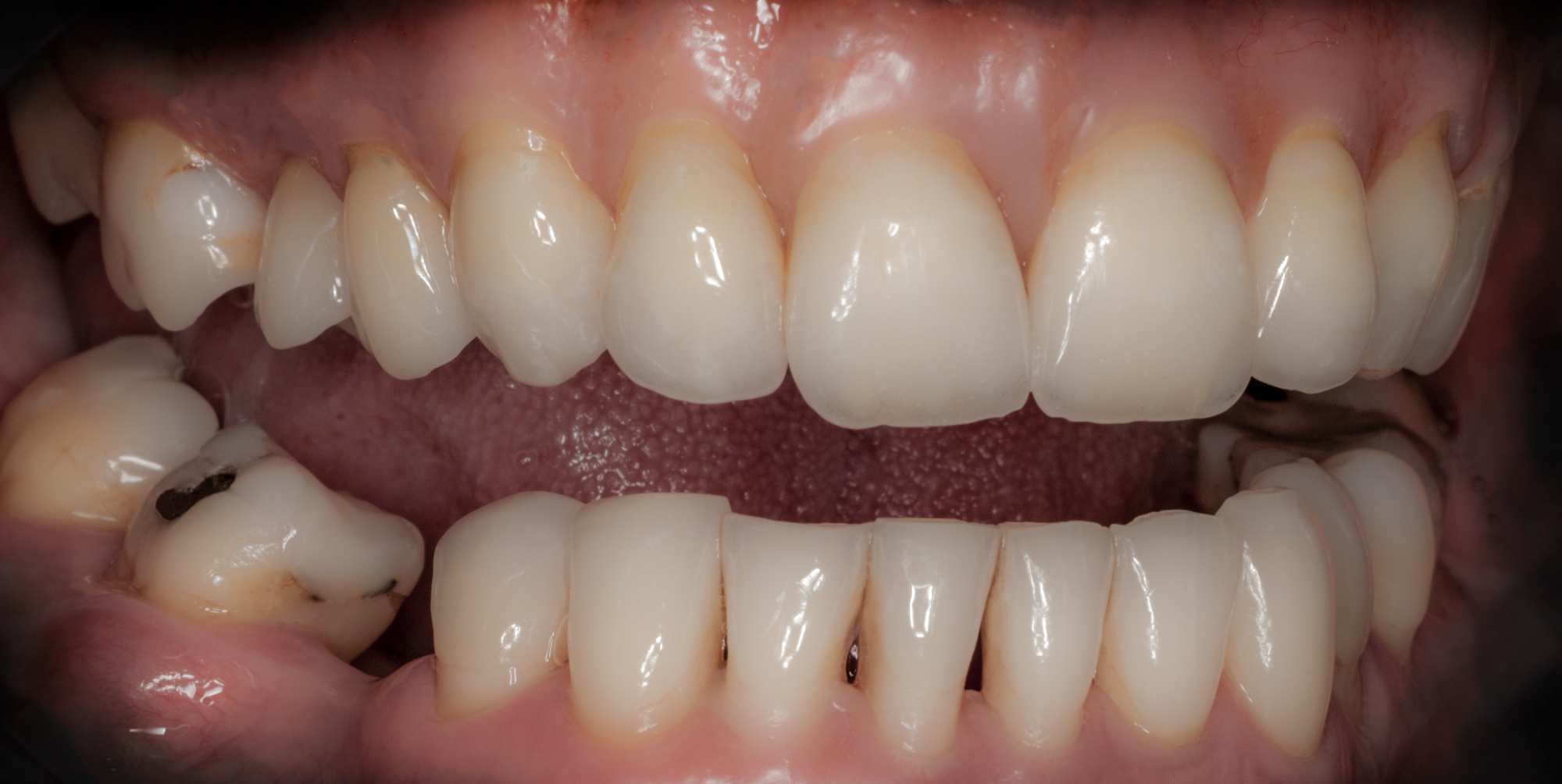 _RCW7478 Lateral-View of beautiful Full Denture by Ron Winter @ Seaside Dental Laboratory & Clinic Takapuna Auckland.jpg