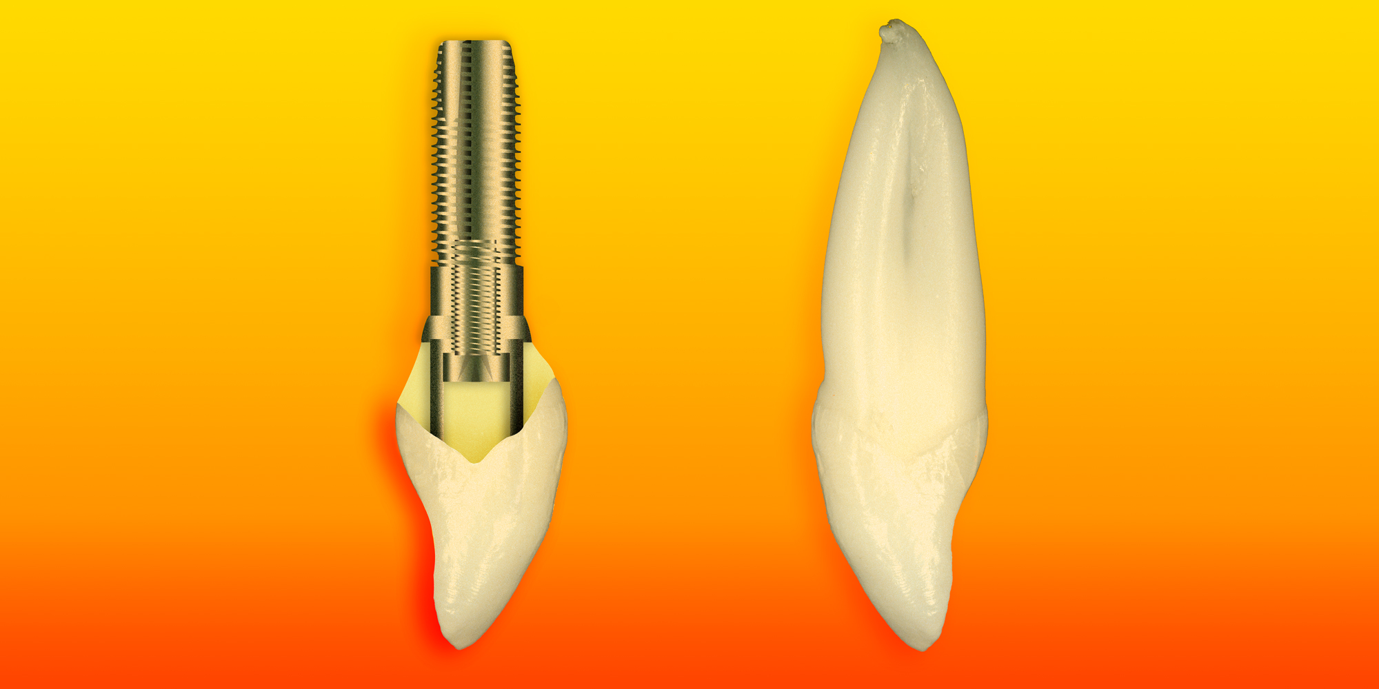 Implant-Abutment-Crown-The-Drawing-v5Fabulous Teeth & Ron Winter know about implants.jpg 