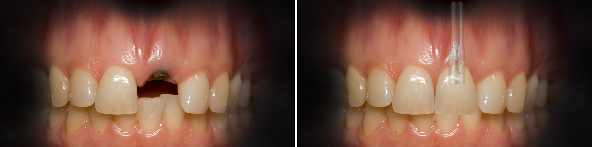Implant-Crown-2-in-1-on-11-v3-02.07.2018Fabulous Teeth & Beautiful Implantsron winter of fabulous teeth @ seaside dental laboratory & clinic Takapuna Auckland New Zealand.jpg 