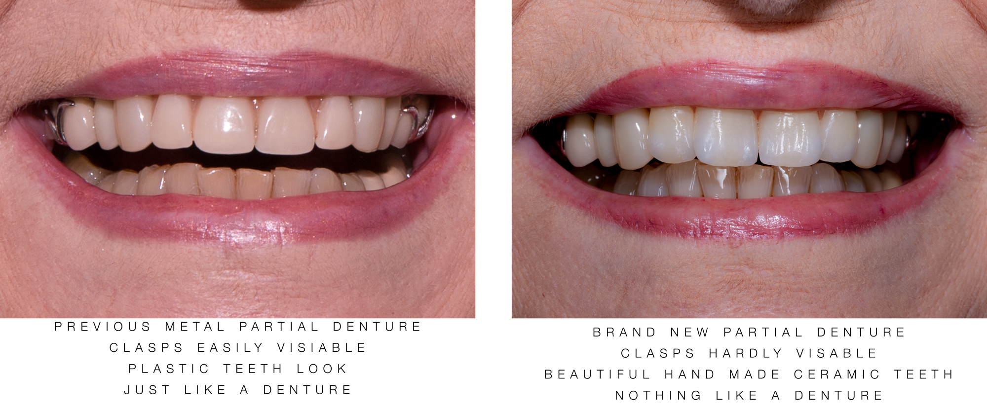 New-Partial-Denture by Ron Winter of Fabulous Teeth @ Seaside Dental Laboratory & Clinic.jpg
