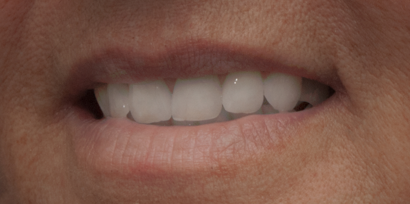 Rosa-RCW3446-Her-Denture-in-Close-Up.jpg