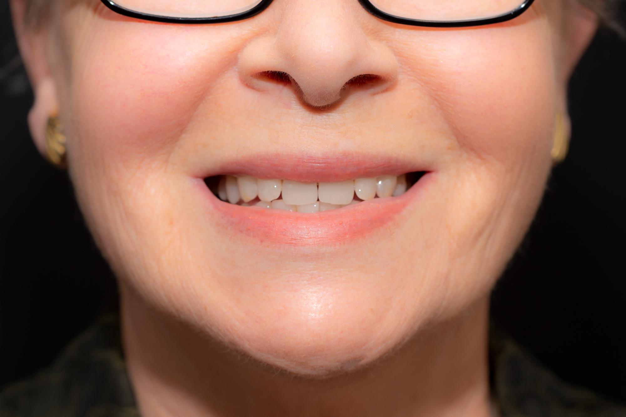 _RCW3628-New-Denture-Ceramic-Teeth-by-Ron-Winter-ofg-Fabulous-Teeth--Seaside-Dental-Laboratory--Clinic-Takapuna-Auckland-NZ.jpg