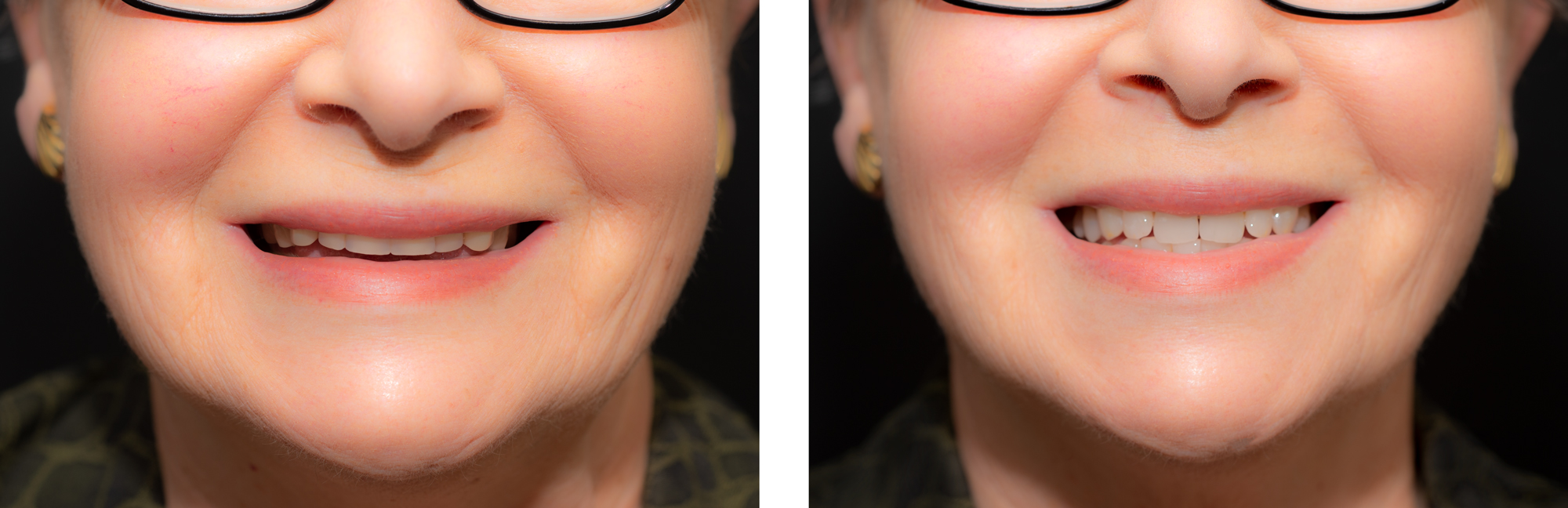Double-Image-NO-Text-Before--After-Full-Upper--Full-Lower-Dentures-by-Ron-Winter-of-Fabulous-Teeth--Seasdide-Dental-Laboratory--Clinic.jpg