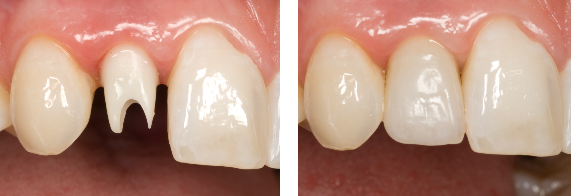 Double-Image-Base-Before--After-Zi-Implant-and-Emax-crown ron winter of fabulous teeth @ seaside dental laboratory & clinic Takapuna Auckland New Zealand .jpg