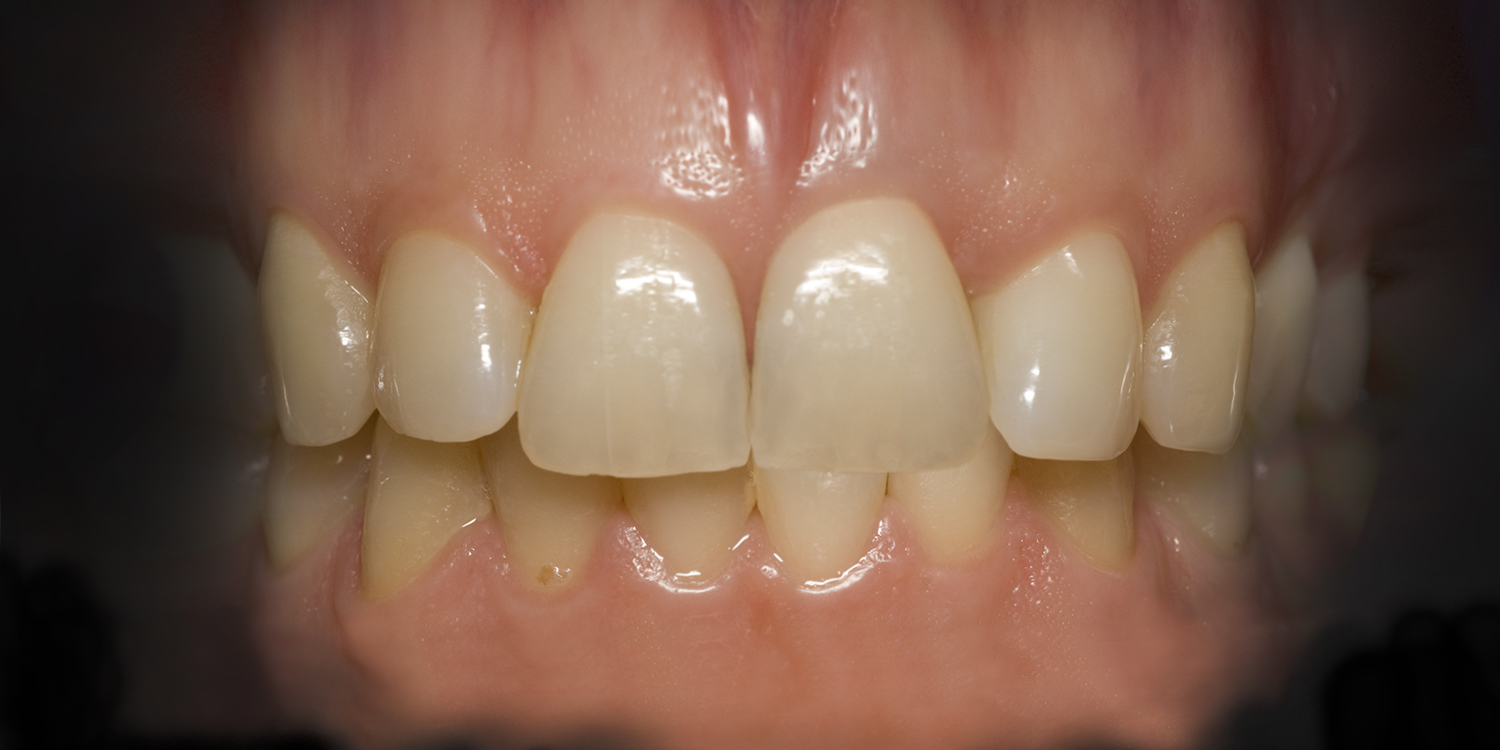 Implant_Crown_on_11-v4_02.07.2018 by Ron Winter of Fabulous Teeth @ Seaside Dental Laboratory & Clinic.jpg